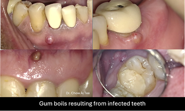 Root canal treatment johor