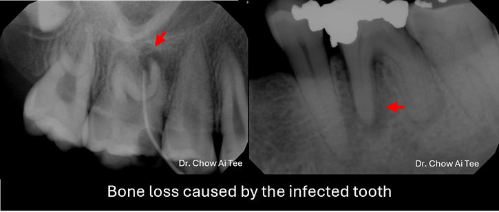 Root canal treatment johor