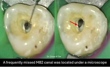 Root canal treatment johor