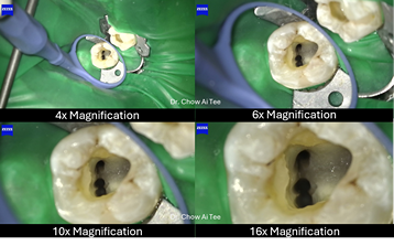 Root canal treatment johor