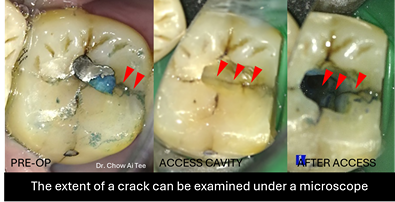 Root canal treatment johor