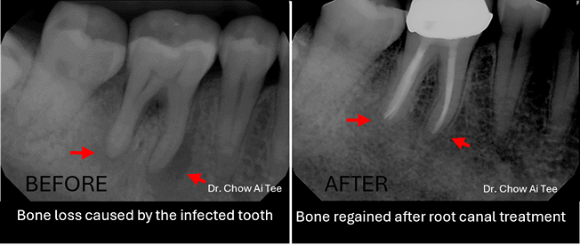 Root canal treatment johor