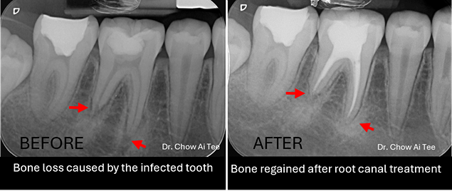 Root canal treatment johor