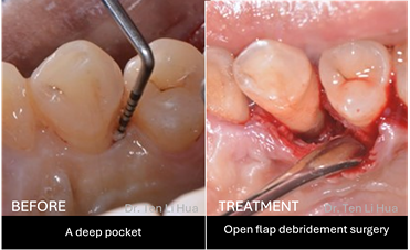 Gum Treatment Johor