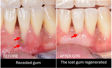 Gum Treatment Johor