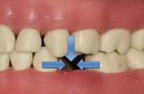 Early loss of baby tooth