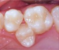 Early loss of baby tooth