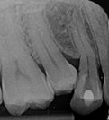 Early loss of baby tooth