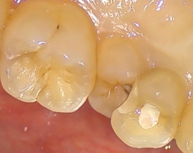 Early loss of baby tooth