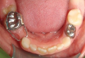 Crown and Loop