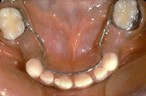 Lingual Arch